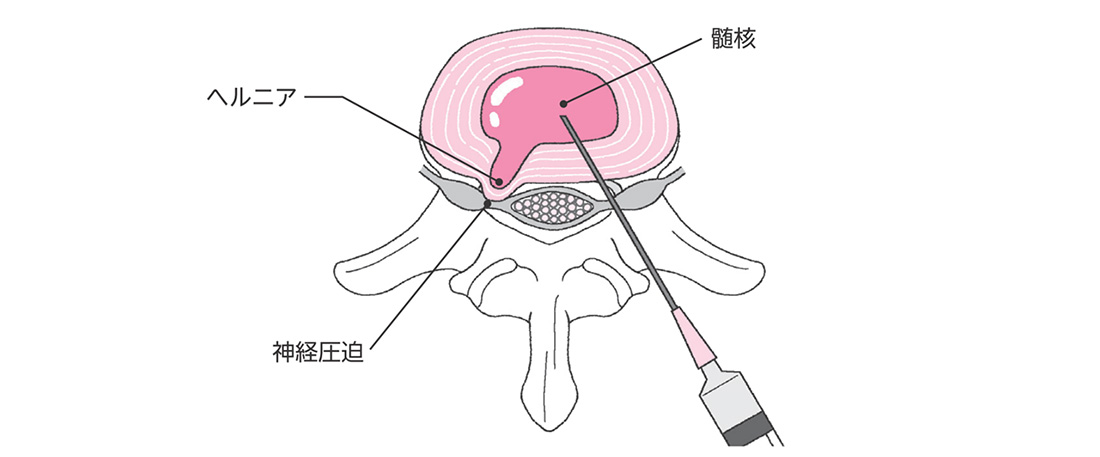 コンドリアーゼ（ヘルニコア）を使用した椎間板内治療のイメージ