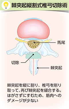 棘突起縦割式腰椎椎弓切除術の図